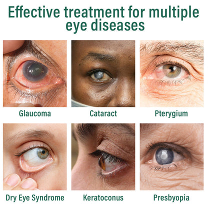 👩‍⚕️Croaie® Nano Eye Drops Serum ✅MHRA Approved(Suitable for presbyopia, dry eye syndrome, glaucoma, and cataracts)❗️